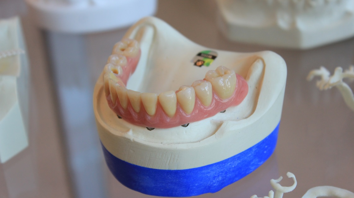 مقایسه ایمپلنت دندان با بریج دندان
