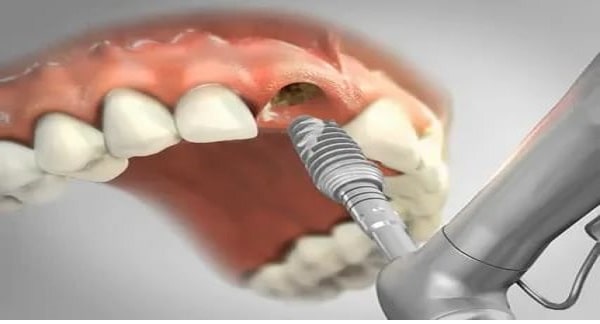 انواع ایمپلنت دندان بر اساس: کشور، نحوه اتصال، نوع جراحی