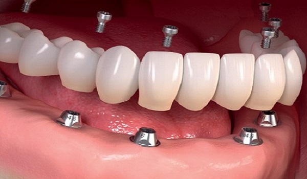 تاج ثابت در کاشت دندان
