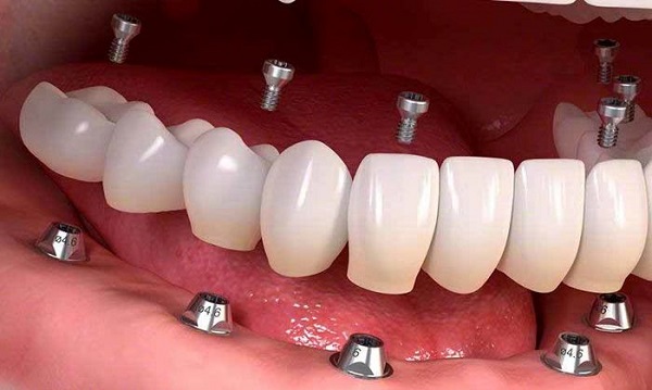 وظیفه و کاربرد ایمپلنت دندان چیست؟