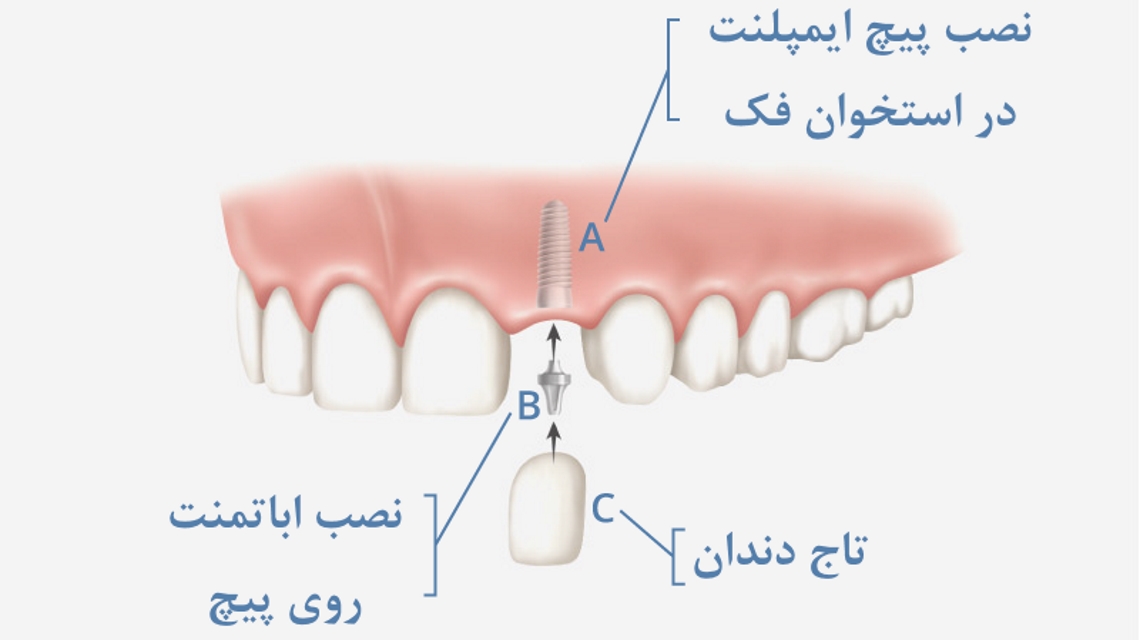 مراحل انجام ایمپلنت یا کاشت دندان