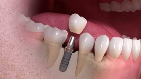 ایمپلنت دندان,فرق لمینت و ایمپلنت,ایمپلنت دندان