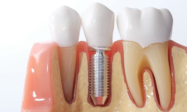 ادغام دندان روی ایمپلنت از مراحل پایانی ایمپلنت دندان