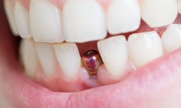 خطرات ایمپلنت دندان