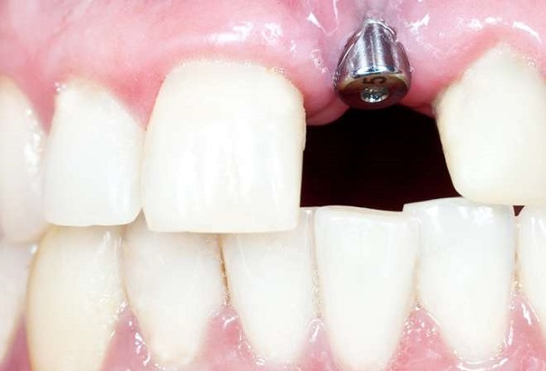 ایمپلنت دندان,بعد از ایمپلنت,دندان متحرک یا ایمپلنت