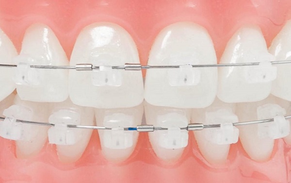 ارتودنسی دیمون با براکت های شفاف از روش های نویس ارتودنسی دندان