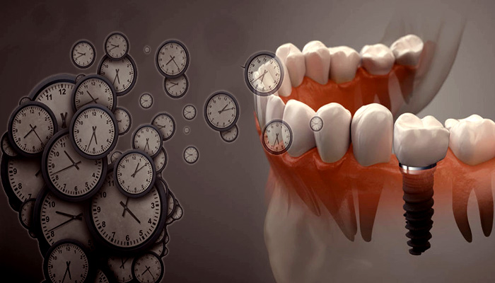 بهترین زمان برای ایمپلنت دندان