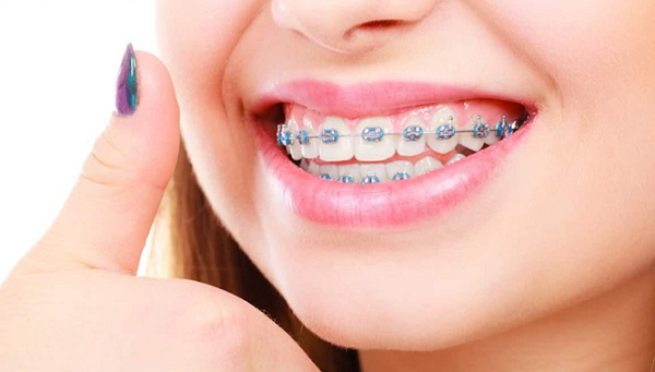 ارتودنسی دندان و رعایت بهداشت آن