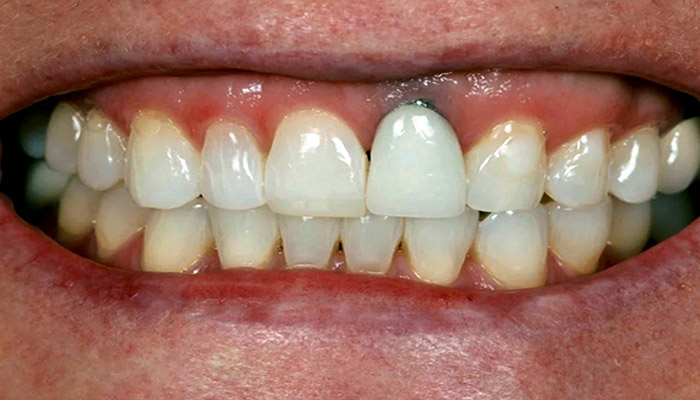 عوارض ایمپلنت دندان در بلند مدت