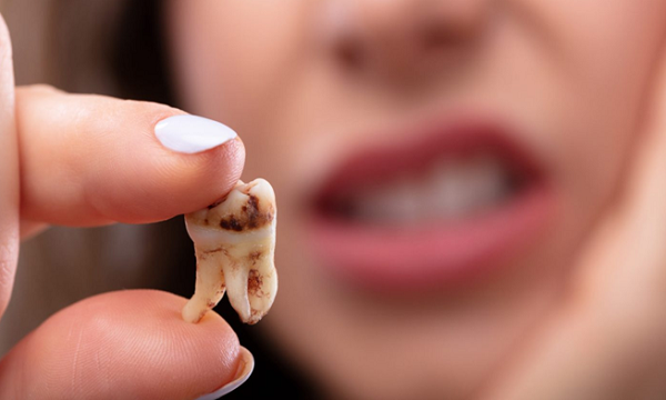 یک دندان پوسیده شده که ظاهر نامناسبی دارد