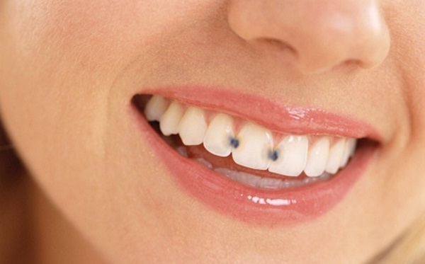 معاینه فیزیکی یا ویزیت مجازی برای تشخیص پوسیدگی دندان