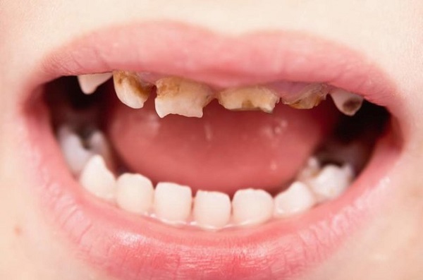 با رعایت بهداشت دهان از پوسیدگی دندان جلوگیری کنید