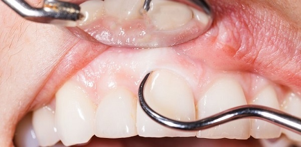 تحلیل رفتن بافت لثه می تواند باعث لق شدن دندان ها شود.