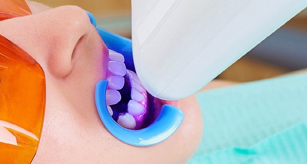 روش حرفه ای در مطب (in office) بلیچینگ دندان