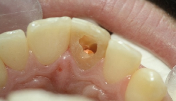 روش اینترنال بلیچینگ دندان