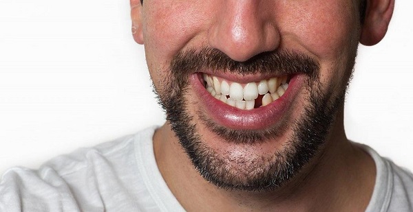انواع راه‌های جایگزین دندان از دست رفته