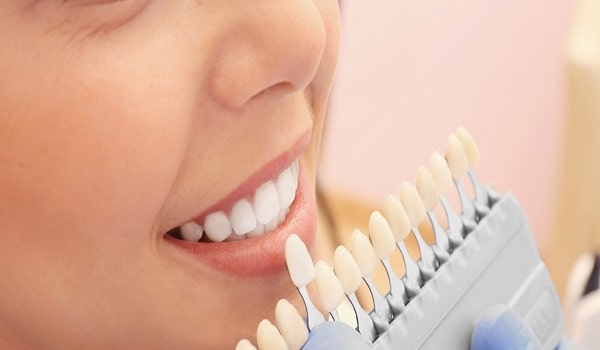 بلیچینگ دندان و رنگ لمینت دندان چه تفاوتی باهم دارند؟
