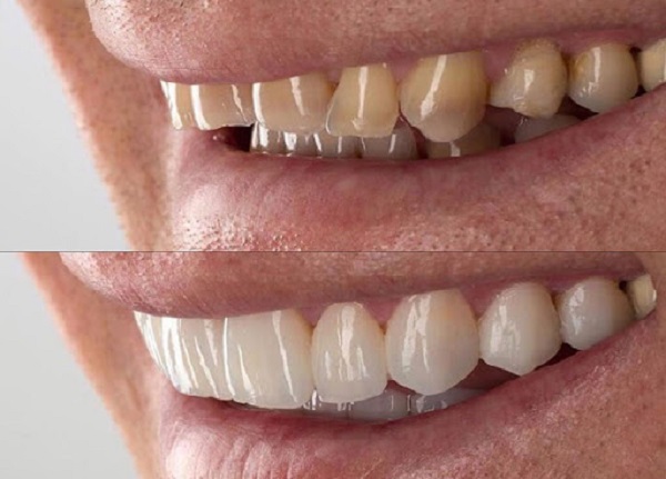 سفید کردن دندان,طرح لبخند,فرق ارتودنسی ثابت و متحرک