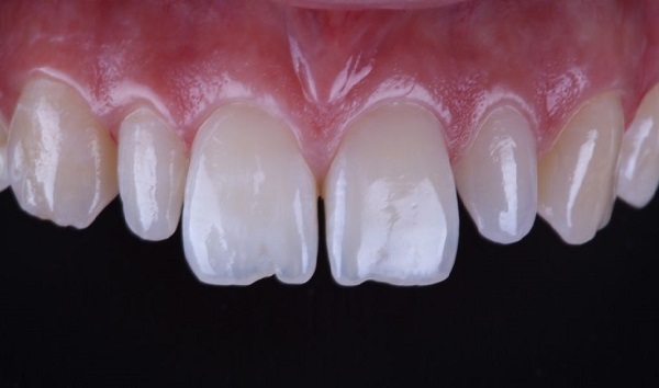 فاصله بین دندان ها که نیاز به ترمیم دارد