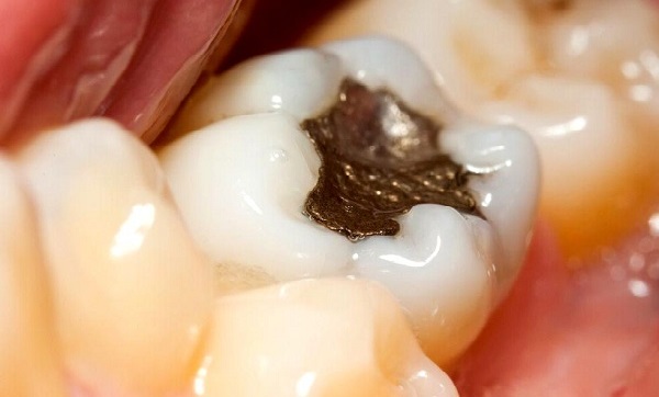 مراحل پر کردن دندان، اول تشخیص دندانپزشک سپس رفع پوسیدگی و پر کردن دندان