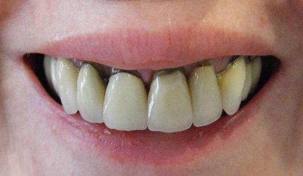ایمپلنت دندان,بعد از ایمپلنت,بهداشت دهان و دندان