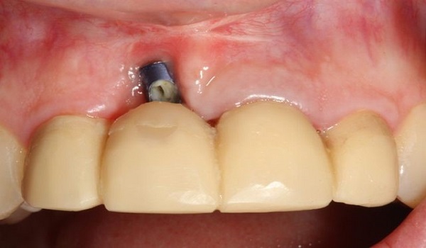  لق شدن ایمپلنت دندان و عفونت آن