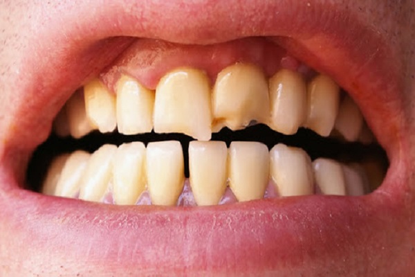 مال اکلوژن (مشکلات فک و دندان),درد دندان,شایع ترین مشکلات دندان