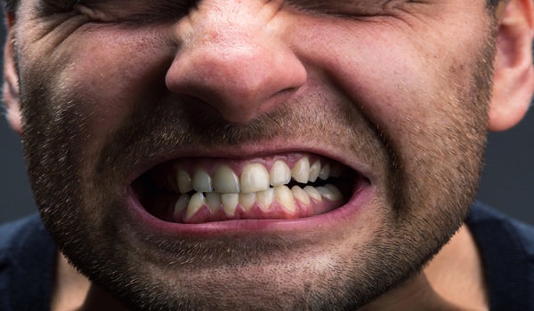 دندان قروچه از عادات بد که باعث خرابی دندان ها می شود