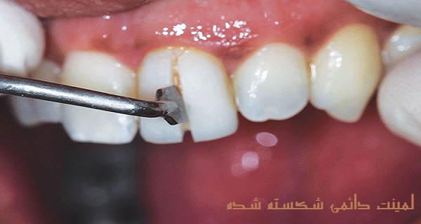 شکستگی و سختی ترمیم، از عوارض لمینت دندان