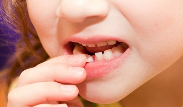 لق شدن بر اثر عصب کشی دندان