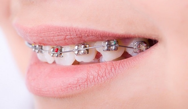 درمان و ترمیم دندان های لق شده با ارتودنسی