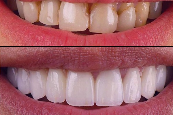 اصلاح رنگ و ظاهر دندان از مزایای لمینت بریلیانس