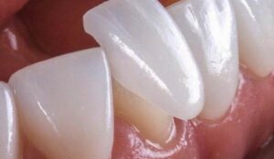 لومینیرز دندان چیست؟