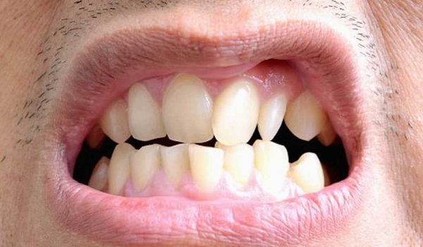 طرح لبخند,مال اکلوژن (مشکلات فک و دندان),مراقبت از دندان