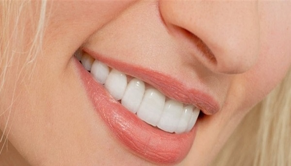 جذابیت لبخند، از مزایای لمینت دندان