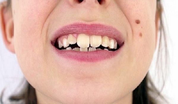 کج شدن دندان
