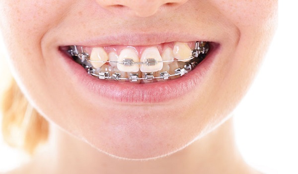 ارتودنسی دندان,بهداشت دهان و دندان,درد دندان