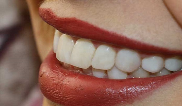 دندان هایی که با پیشگیری های لازم از کج شدگی، سالم رشد کرده اند