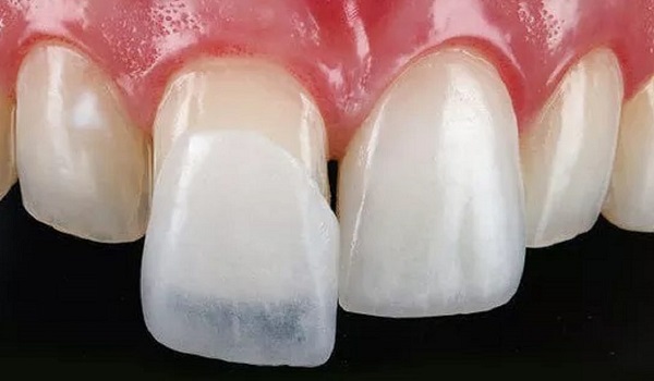 https://clinicgholhak.com/ جنس کامپوزیت دندان