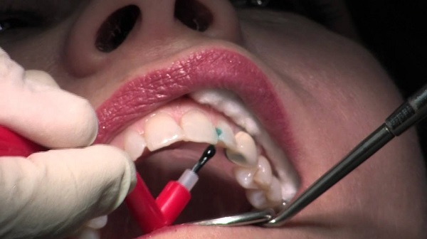 معایب و عوارض احتمالی کامپوزیت دندان
