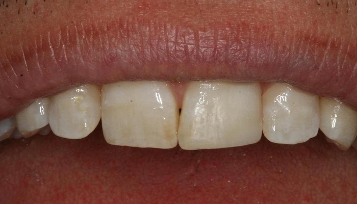 رعایت اصول بهداشت دهان و دندان، از مراقبت های بعد از کامپوزیت دندان