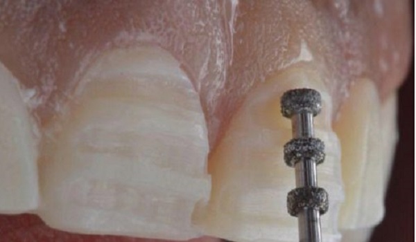 تراشیده شدن مینای دندان ها از عوارض کامپوزیت دندان