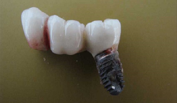 ایمپلنت ناموفق دندان