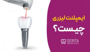 ="ایمپلنت
