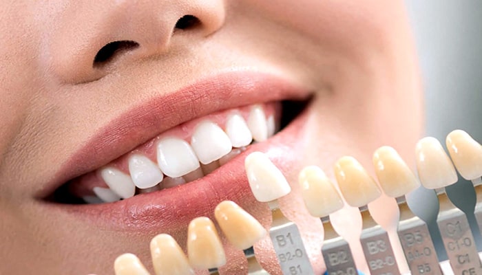 تغییر رنگ دندان,تفاوت بلیچینگ و لمینت,درمان فاصله بین دندان