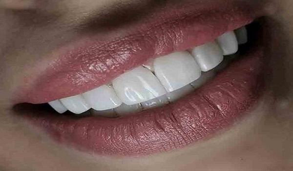 لمینت دندان,انواع لمینت دندان,ایمپلنت بهتر است یا کامپوزیت