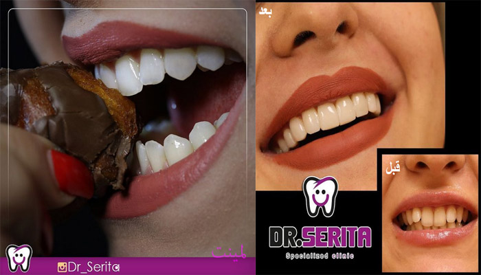 دو نمونه از نتایج لمینت و کامپوزیت دندان