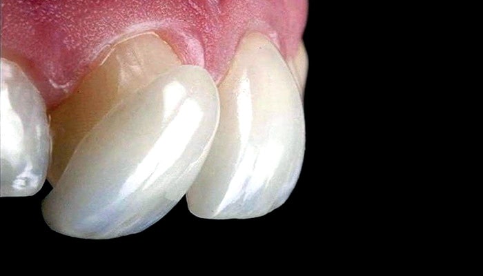 ظاهر لمینت دندان و مقایسه آن با کامپوزیت دندان