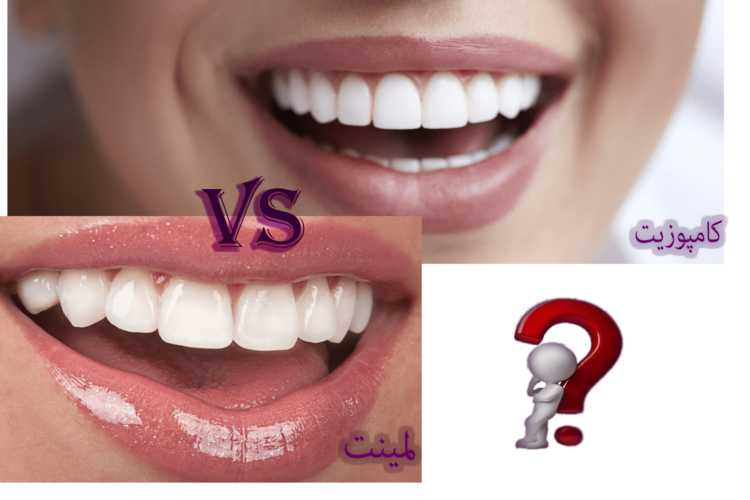 مقایسه ظاهر لبخند با لمینت و کامپوزیت دندان