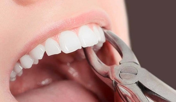 ایمپلنت دندان کشیده شده نوعی از ایمپلنت بدون جراحی محسوب می شود.